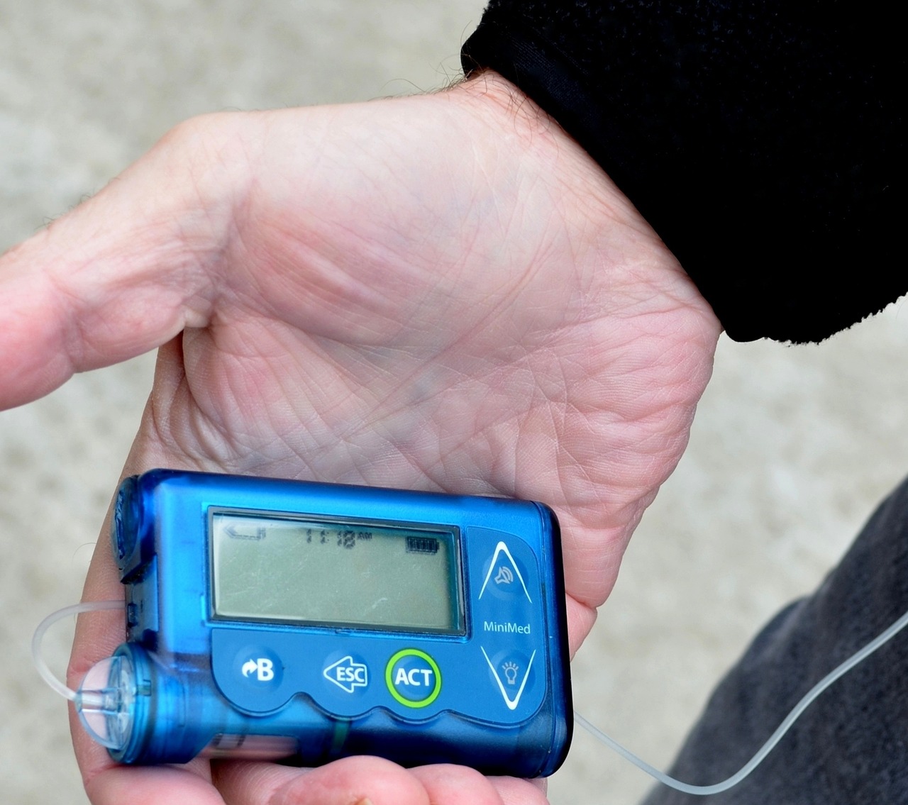 diabetes device